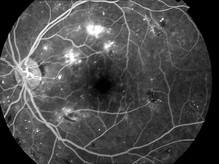 normal retina fluorescien angiography