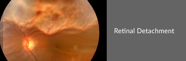 eye retina detachment operation