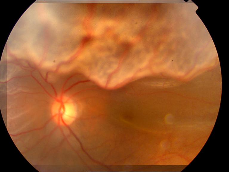 detached retina