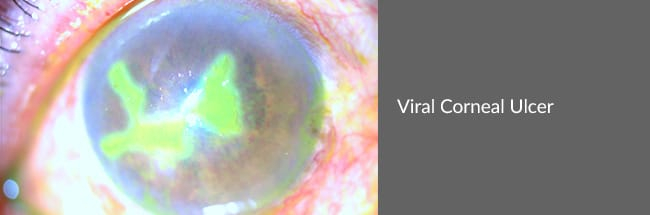 ViralCornealUlcer