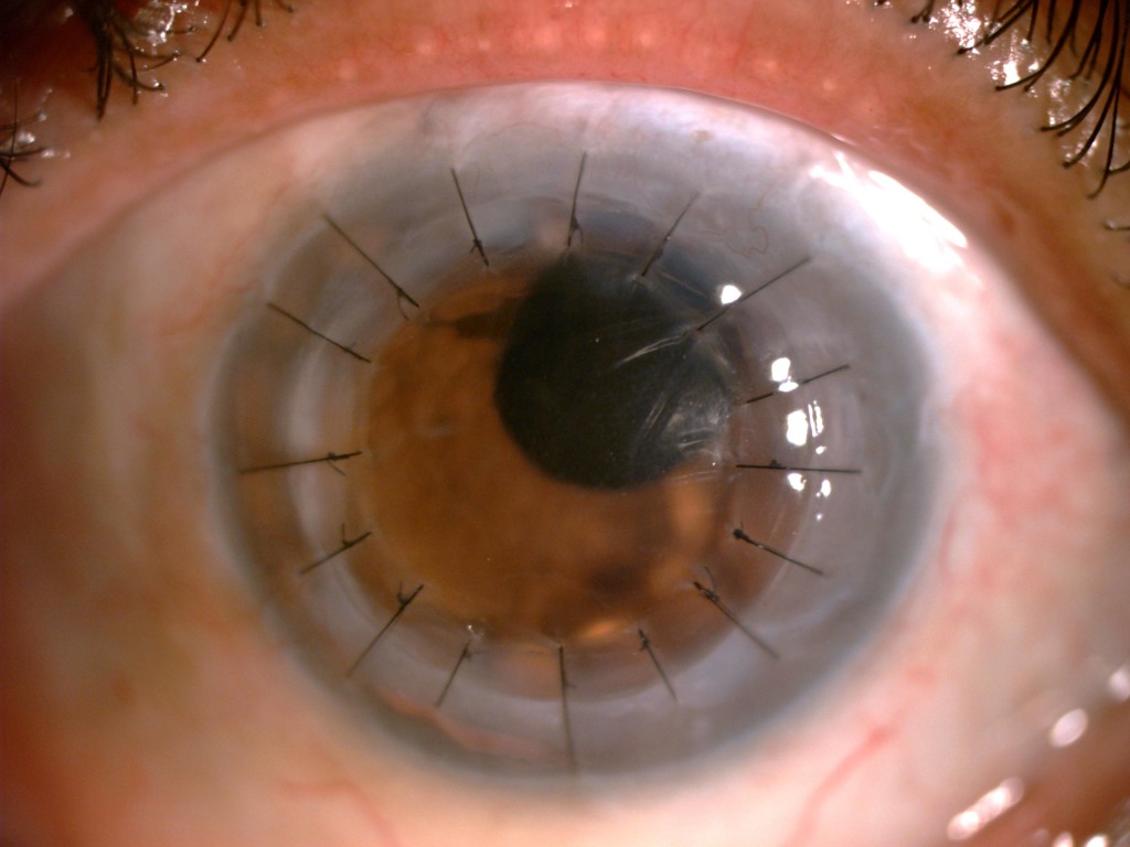Corneal Transplant Amritsar Eye Clinic