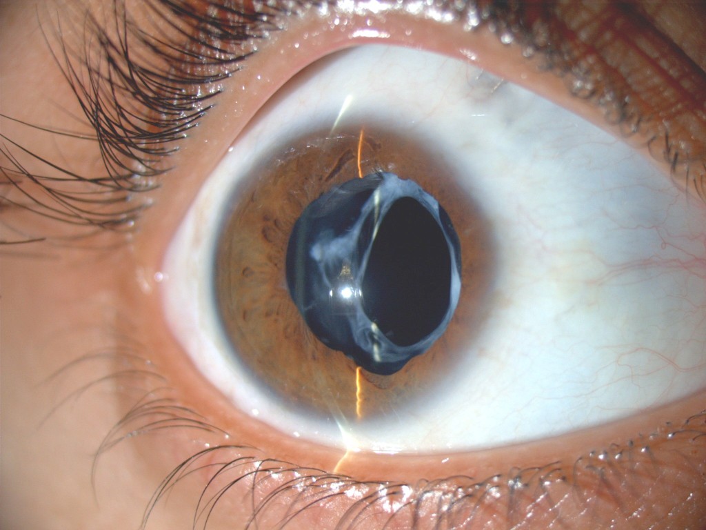 Cataract Surgery Amritsar Eye Clinic